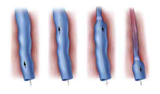 The Principle of VNUS EVLT catheter closure of the varicose vein